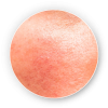 Rosacea